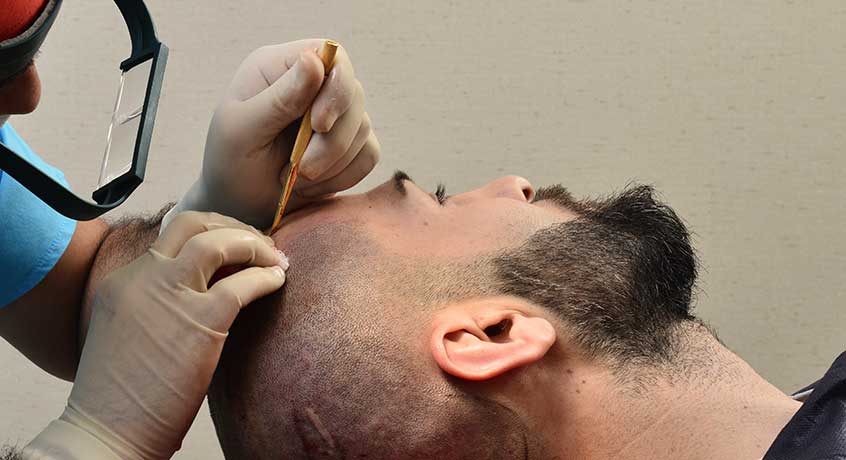 Saç ekimi fiyatları İstanbul'da ne kadar? Modern klinikte saç ekimi sürecini gösteren erkek hasta görseli.